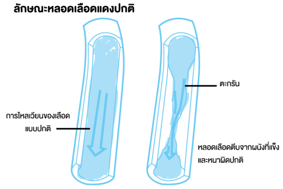ลักษณะหลอดเลือดตีบ