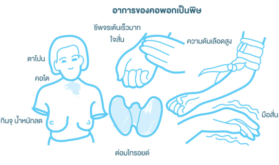 อาการของคอพอกเป็นพิษ