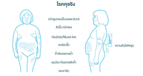 โรคคุชชิ่ง พิษจากยาชุดลูกกลอน