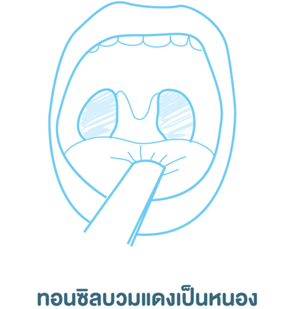 ทอนซิลบวมแดงเป็นหนอง