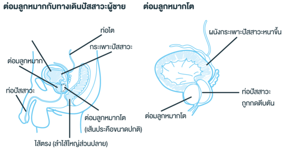 อัณฑะบิดตัว
