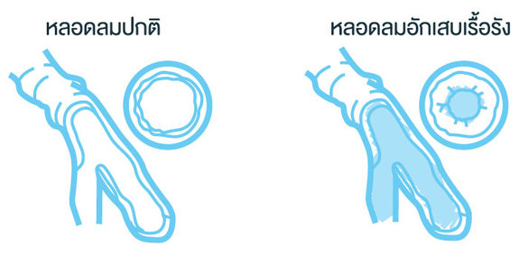 หลอดลมอักเสบเรื้อรัง