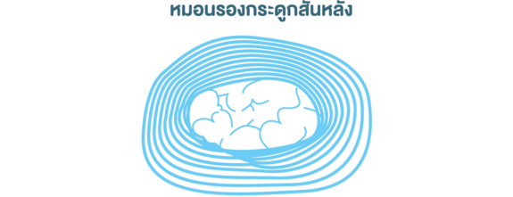 หมอนรองกระดูกเคลื่อน