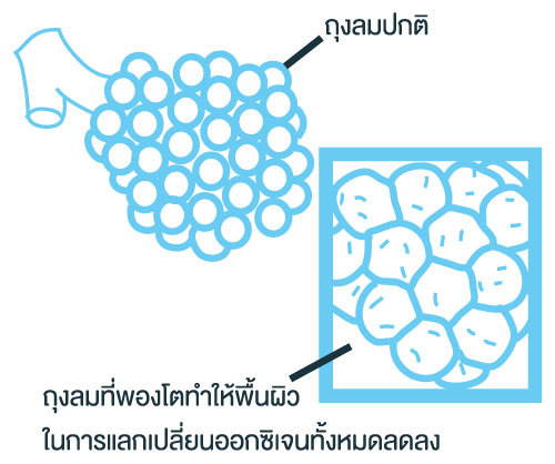 ถุงลมโป่งพอง