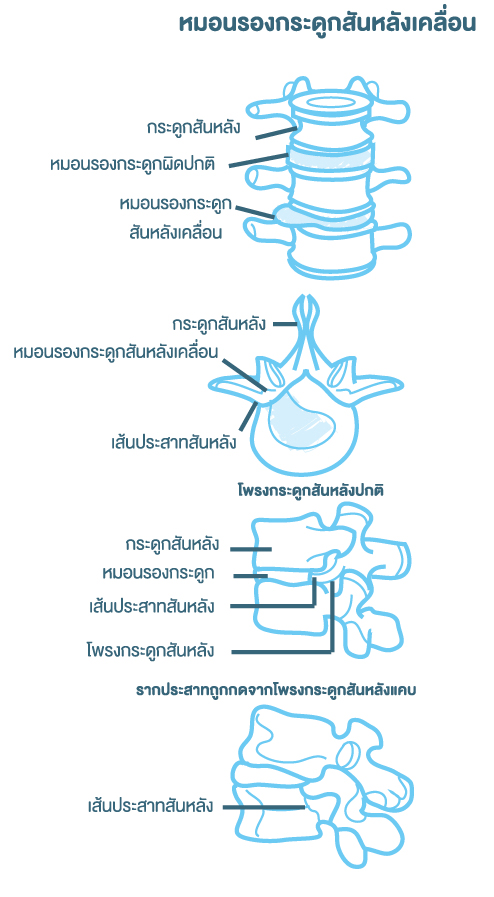 หมอนรองกระดูกสันหลังเคลื่อน