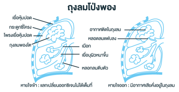 ถุงลมปอดโป่งพอง