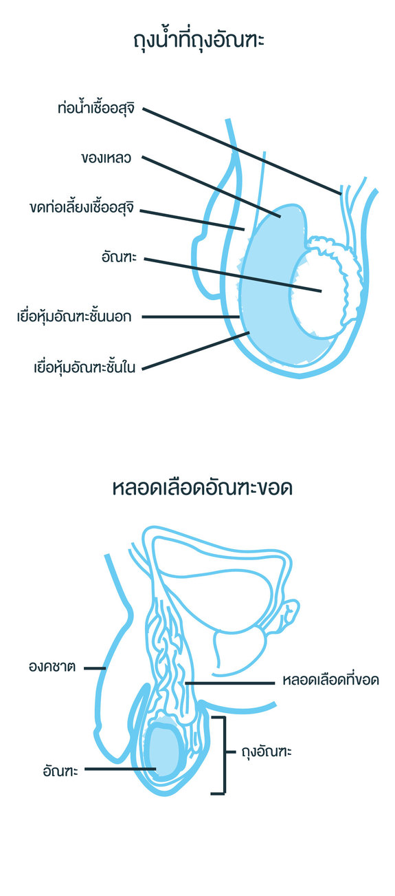 หลอดเลือดอัณฑะขอด