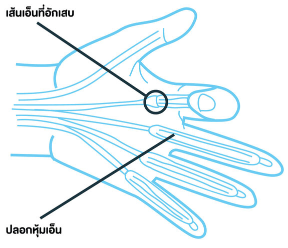 นิ้วล็อก