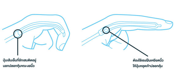 นิ้วล็อก