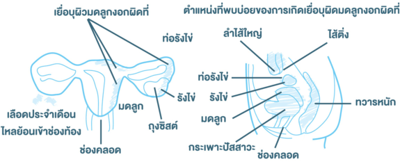 หิด