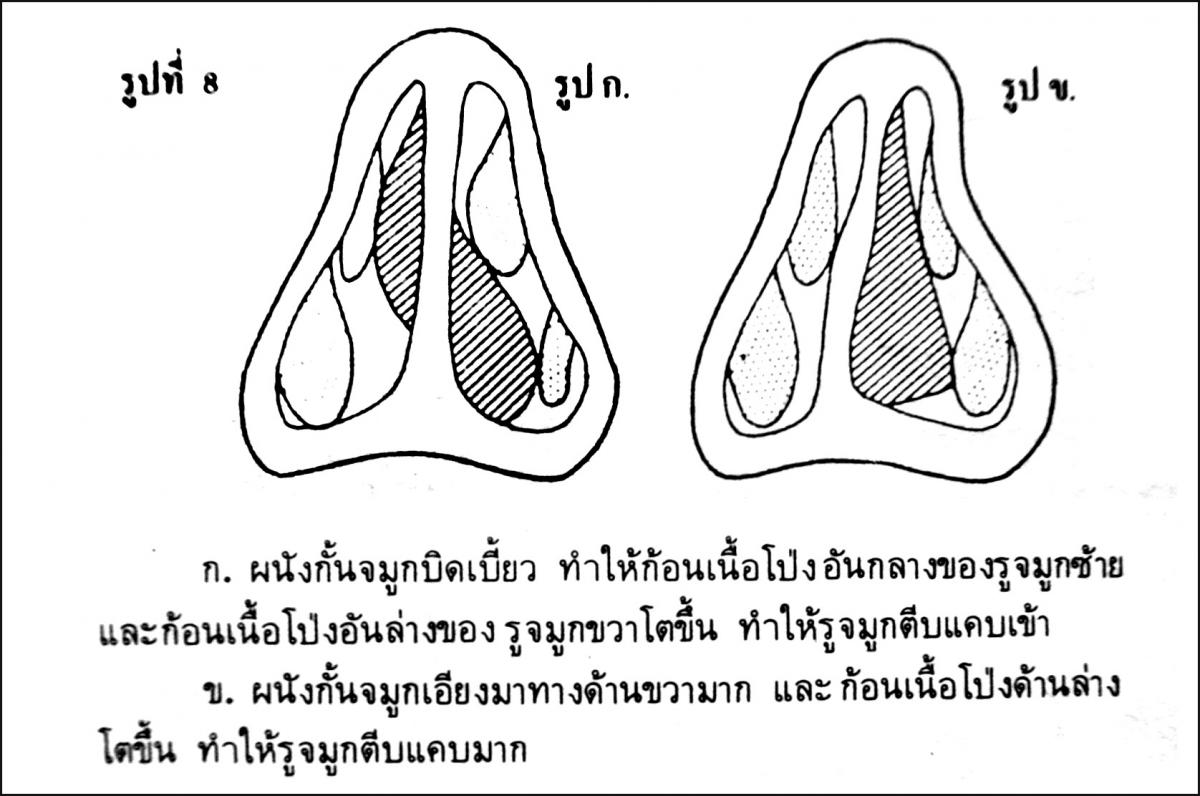 คัดจมูกข้างเดียว